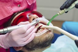 Limpieza dental ultrasónica